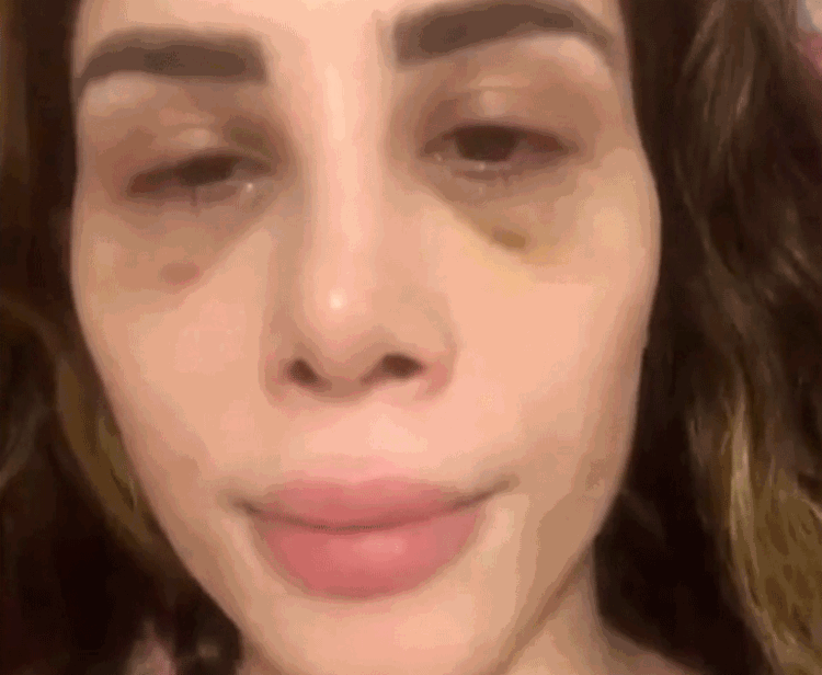 Camilla Uckers chocou os internautas ao postar as fotos dos hematomas - Foto: Reprodução | Instagram Camilla Uckers chocou os internautas ao postar as fotos dos hematomas - Foto: Reprodução | Instagram