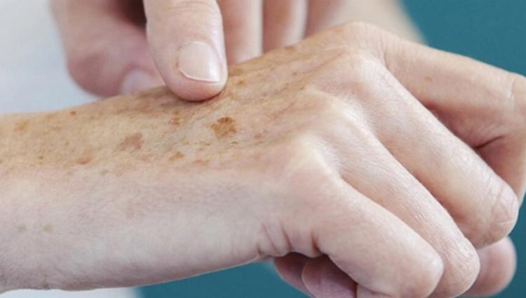 Pessoas com idade de 44 a 80 anos foram as que mais deixaram de fazer as avaliações dermatológicas na pandemia | Foto: Divulgação - Foto: Divulgação